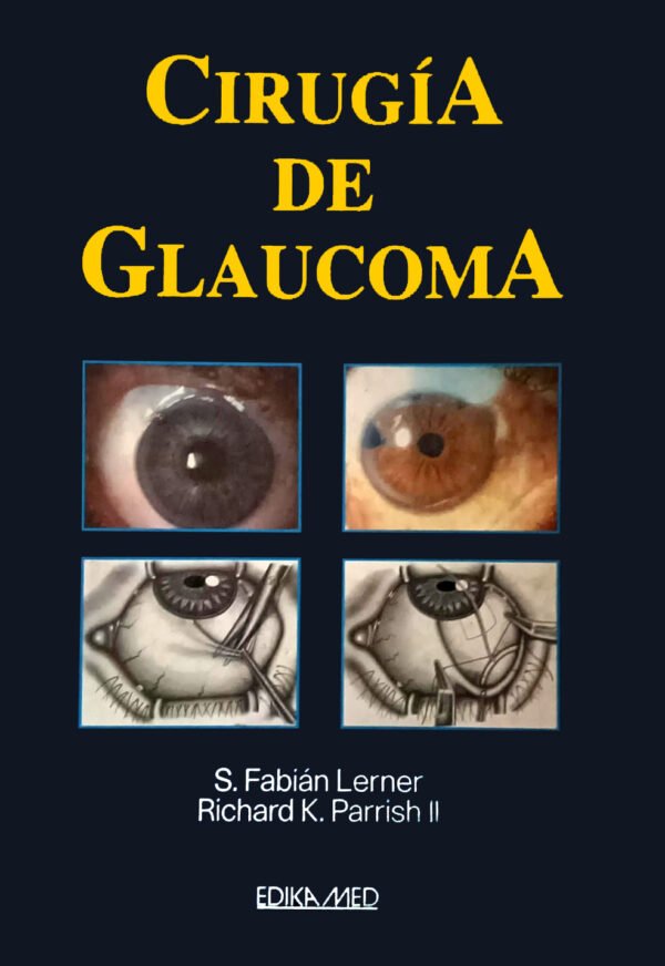 Cirugia de Glaucoma