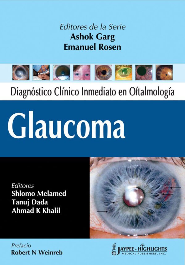 DIAGNÓSTICO CLÍNICO INMEDIATO EN OFTALMOLOGÍA GLAUCOMA