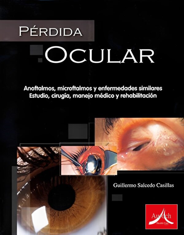 PERDIDA OCULAR